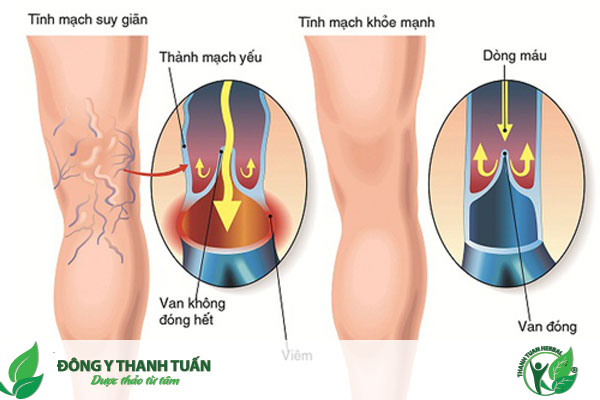 Bệnh suy giãn tĩnh mạch chi dưới