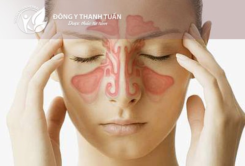 triệu chứng viêm xoang cấp