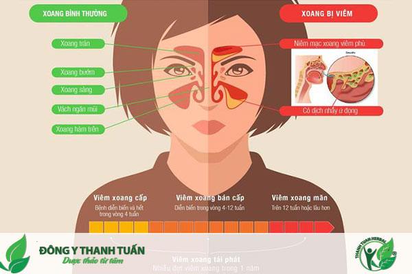 Viêm đa xoang mạn tính làm cho bạn luôn cảm thấy mệt mỏi
