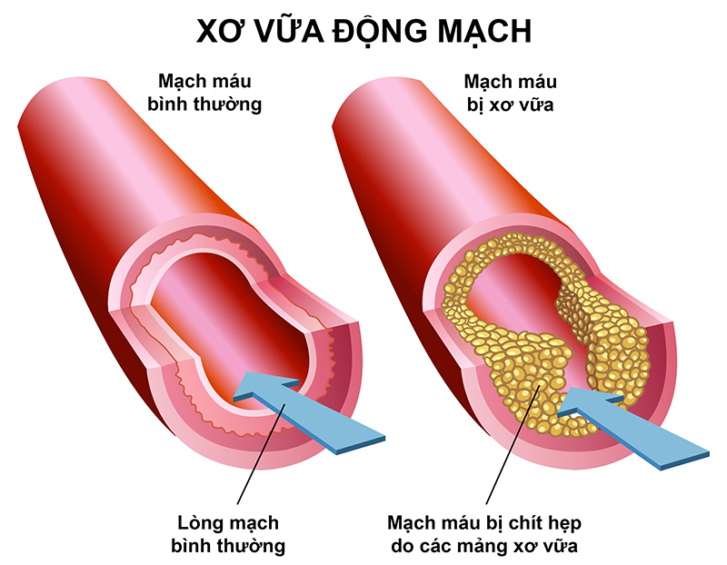 xơ vữa động mạch mỡ trong máu