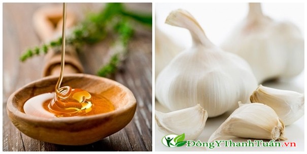 Tỏi và mật ong rất hiệu quả trong việc điều trị viêm mũi dị ứng