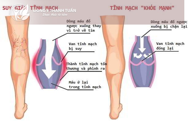 Bệnh suy giãn tĩnh mạch chi dưới