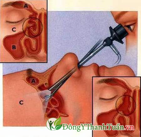 bệnh viêm xoang và cách chữa trị 2