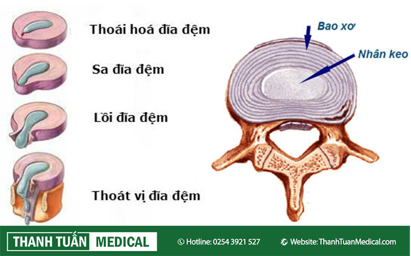 cac-giai-doan-của-thoat-vi-dia-dem