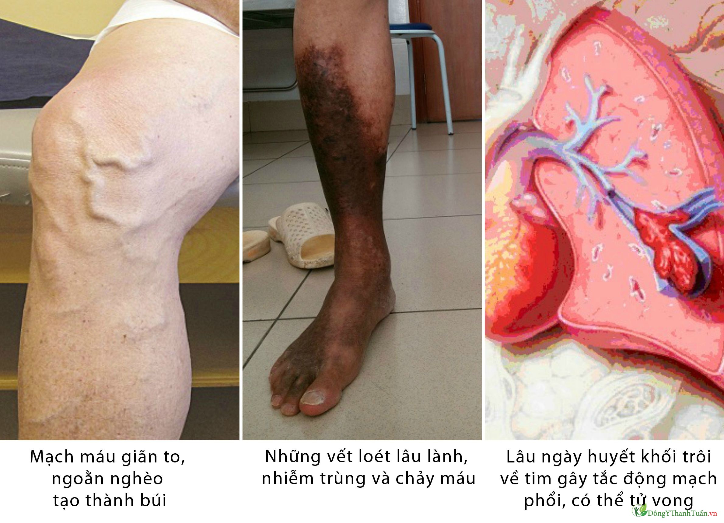 Cách điều trị suy giãn tĩnh mạch chân nào tốt
