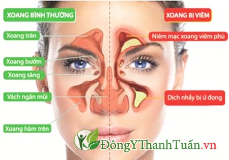 Cách phòng và trị bệnh viêm xoang dễ mắc phải
