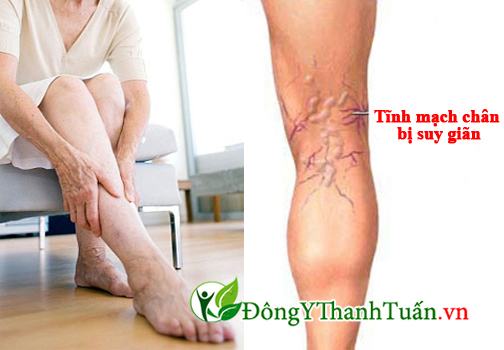 Phù chân là dấu hiệu của bệnh giãn tĩnh mạch chi dưới
