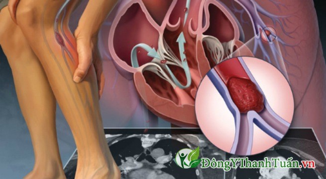 Dấu hiệu bệnh suy tĩnh mạch chi dưới