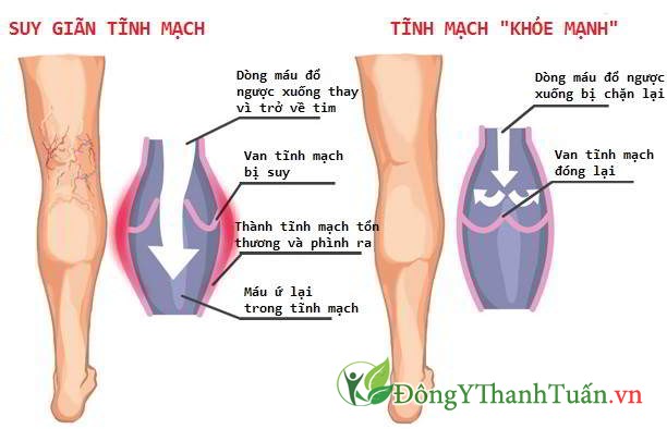 Điều trị giãn tĩnh mạch chân bằng đông y