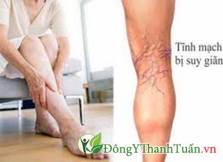 Giãn tĩnh mạch chân có nguy hiểm không 02