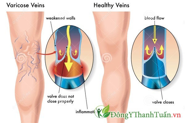 Giãn tĩnh mạch chân và cách điều trị 02