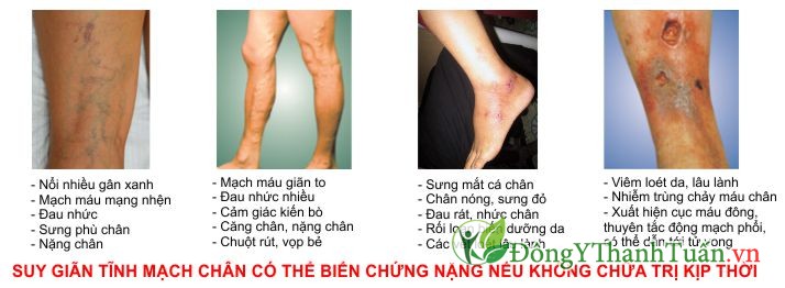Hậu quả bệnh suy tĩnh mạch chi dưới