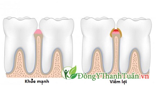 hôi miệng 04