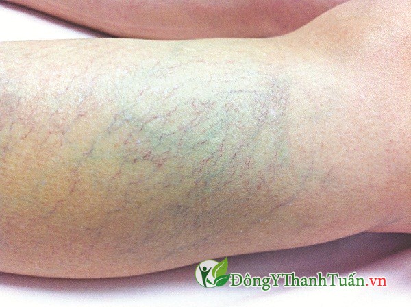 Triệu chứng suy giãn tĩnh mạch