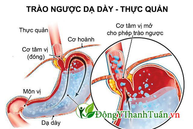 trào ngược dạ dày thực quản gây hôi miệng