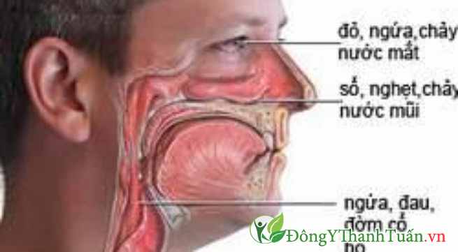 triệu chứng viêm mũi dị ứng