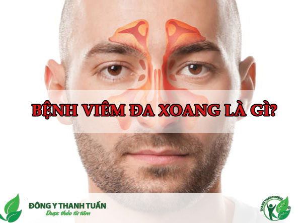 Viêm đa xoang gây nhiều phiền toái