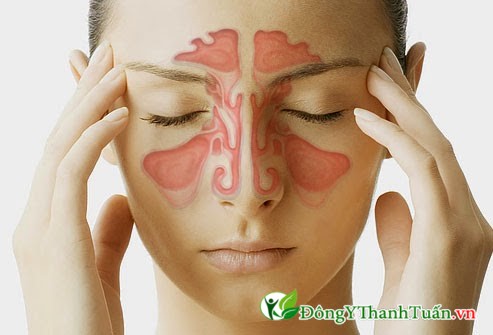 Viêm xoang là bệnh khá phổ biến hiện nay